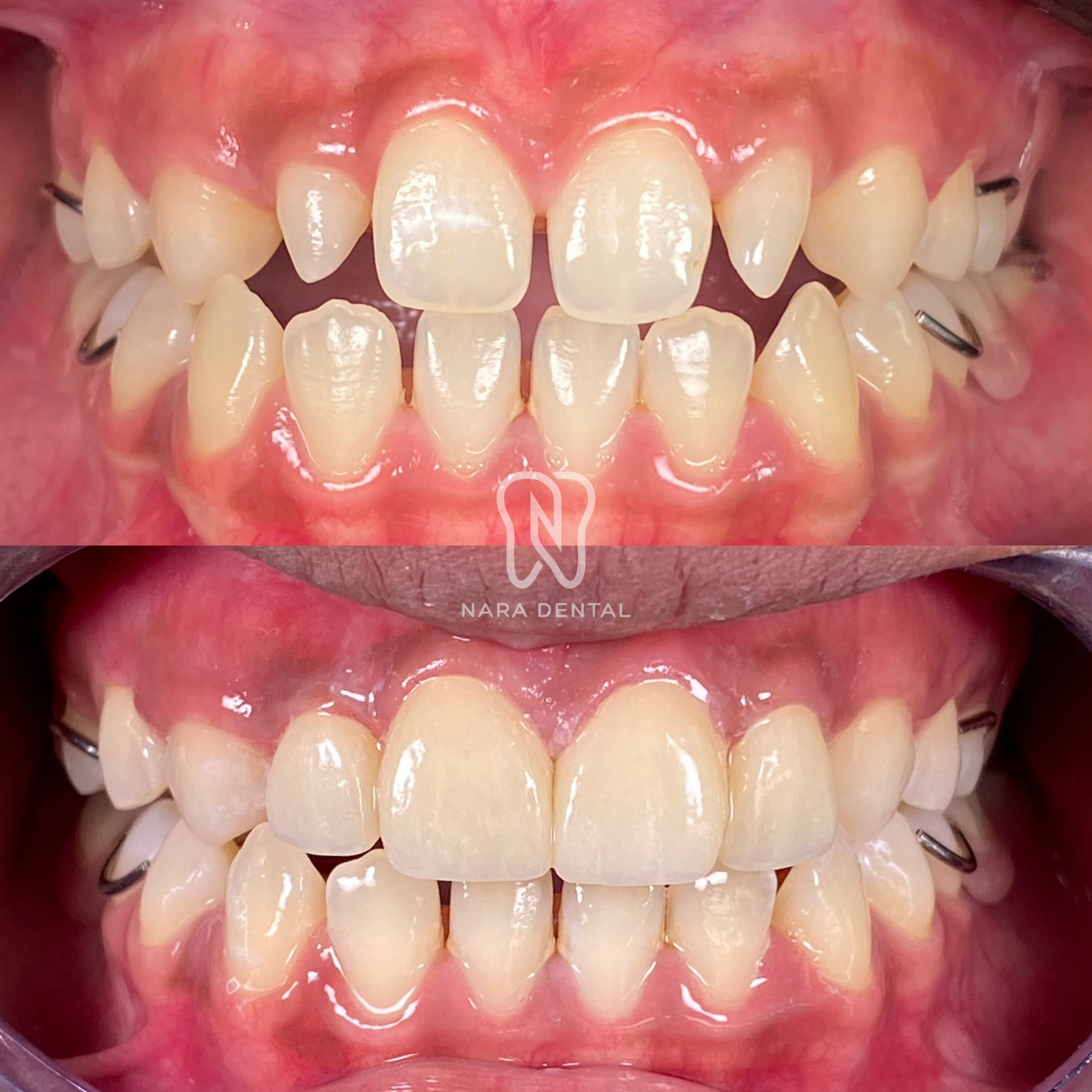 Veneer & Mahkota Gigi (Indirect Veneer)